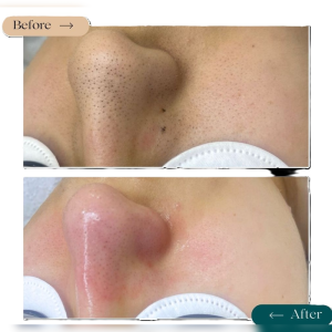 Royal Blanco Treatment