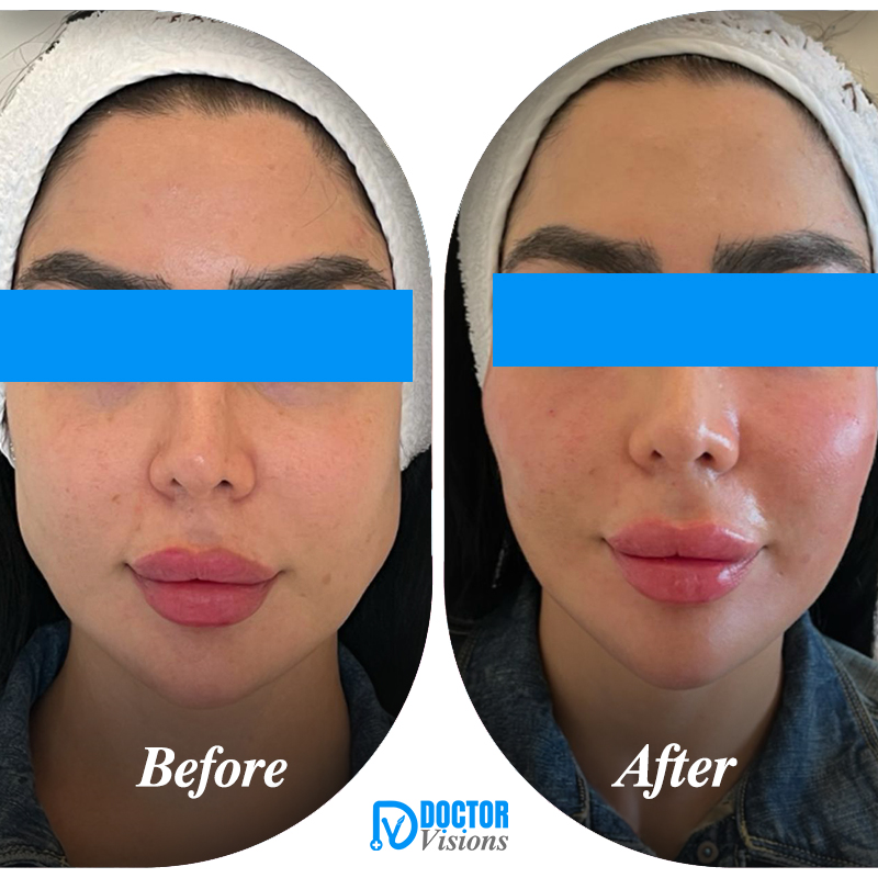 Cleopatra Lift Makeover - Image 2