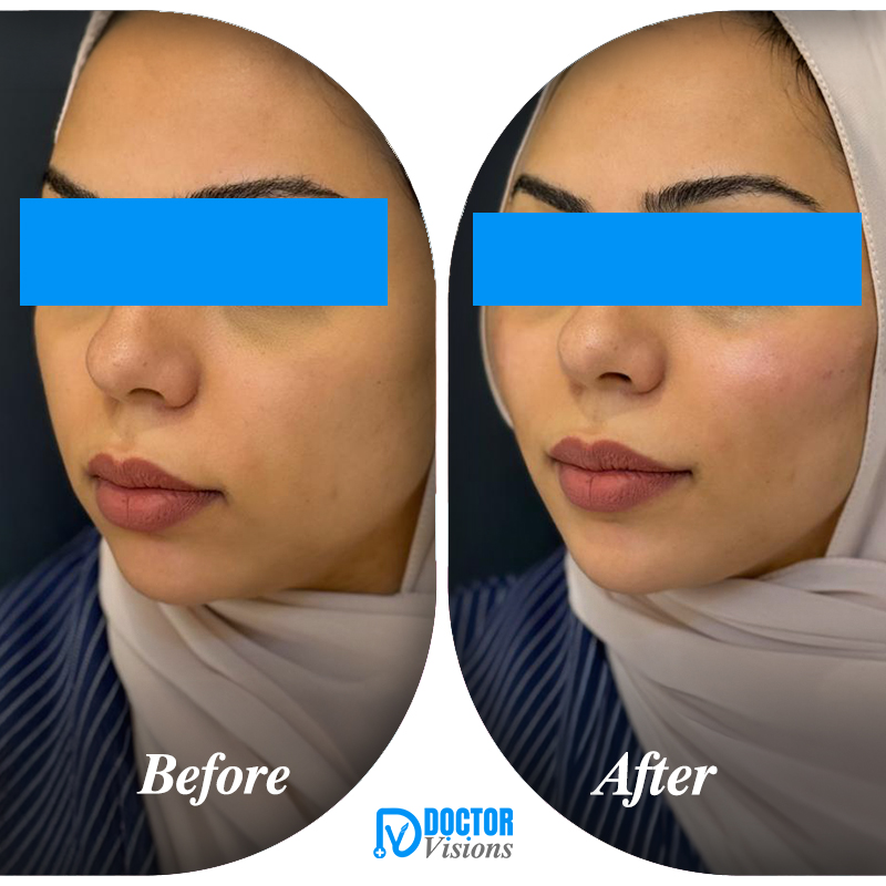 Cleopatra Lift Makeover