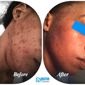 Snow White skin treatment