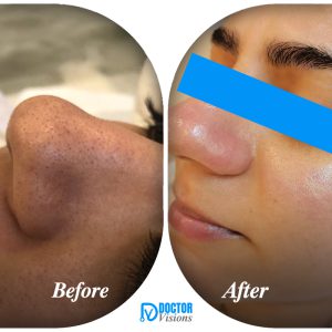 Super glowing treatment