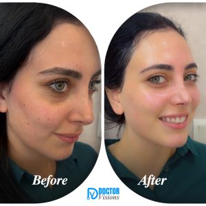 Skin transformation treatment